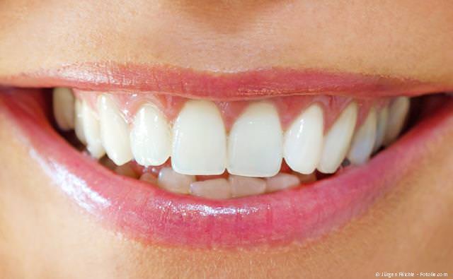 Schöne Zähne mit Bleaching (Zahnaufhellung), Veneers und mehr