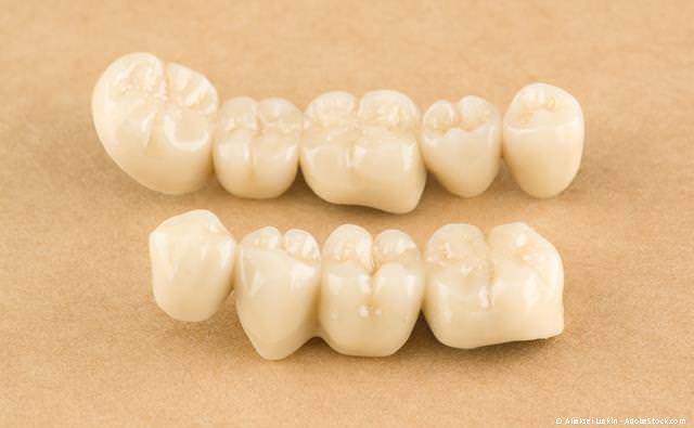 Zahnbrücken -auch aus Keramik - zum Schließen kleiner Zahnlücken